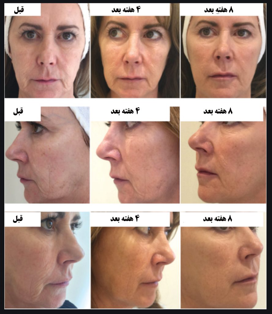 تاثیر تزریق پروفایلو