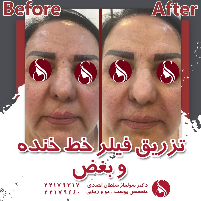 تزریق فیلر برای رفع خط خنده دکتر سلطان احمدی