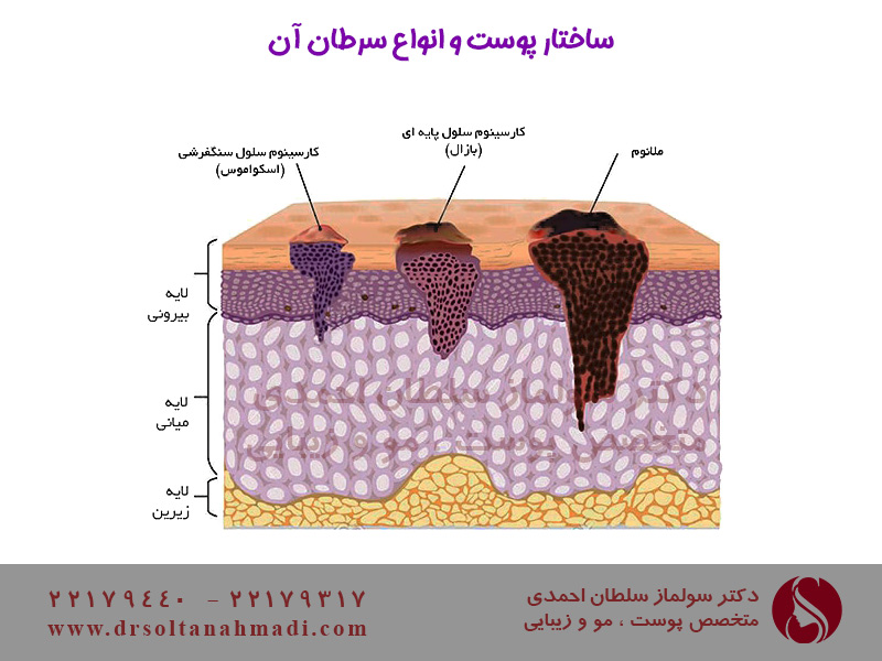 ساختار پوست و انواع سرطان پوست