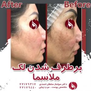 برطرف شدن لک ملاسما با مزوتراپی