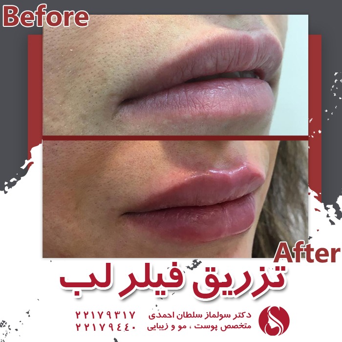 نمونه تزریق فیلر لب