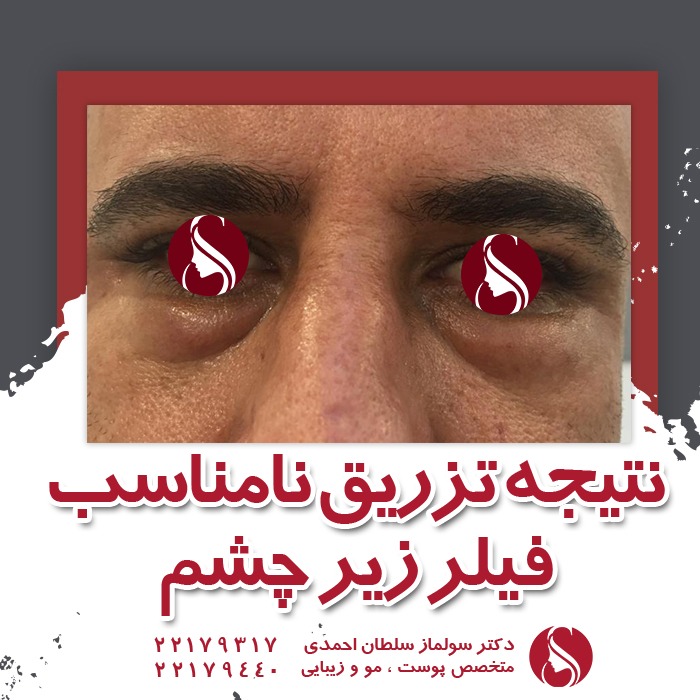 تزریق نامناسب فیلر