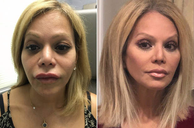 تزریق نامناسب فیلر لب