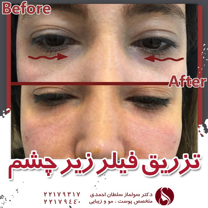 تزریق فیلر زیر چشم
