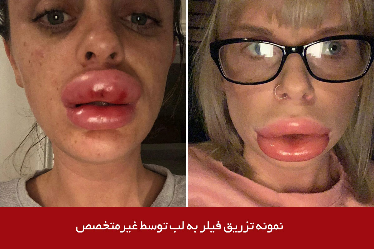 نتیجه تزریق نامناسب فیلر به لب