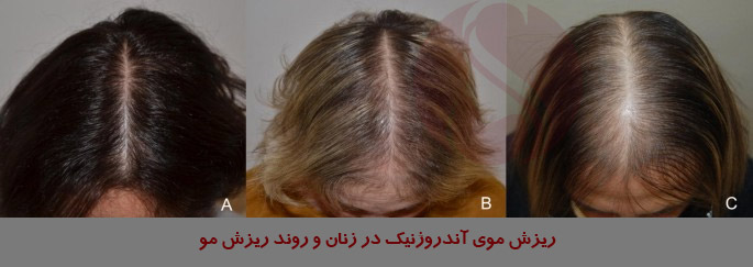 ریزش موی آندروژنیک