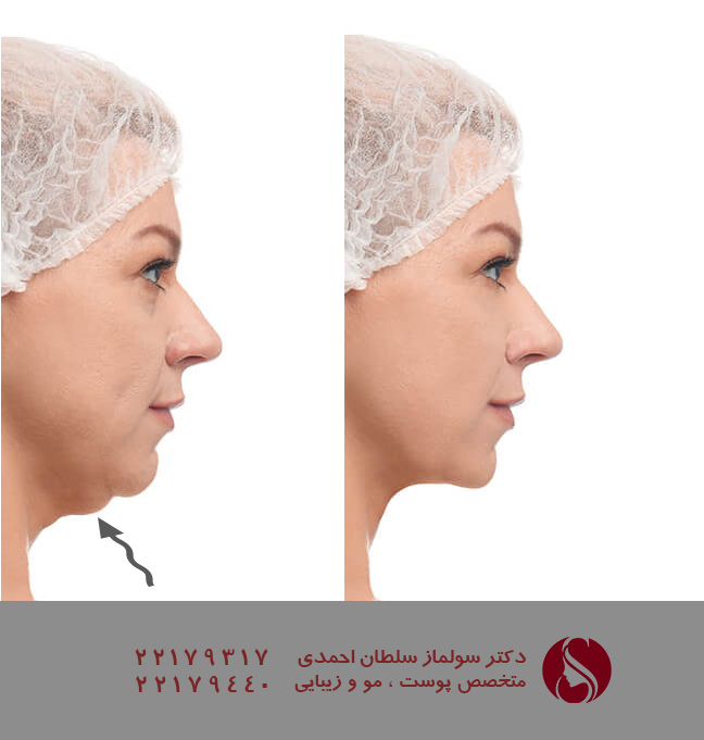 بعد از درمان غبغب