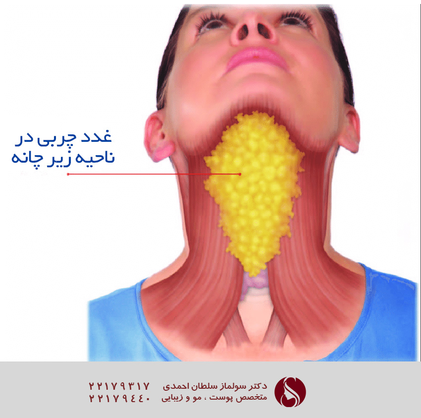 چربی های غبغب