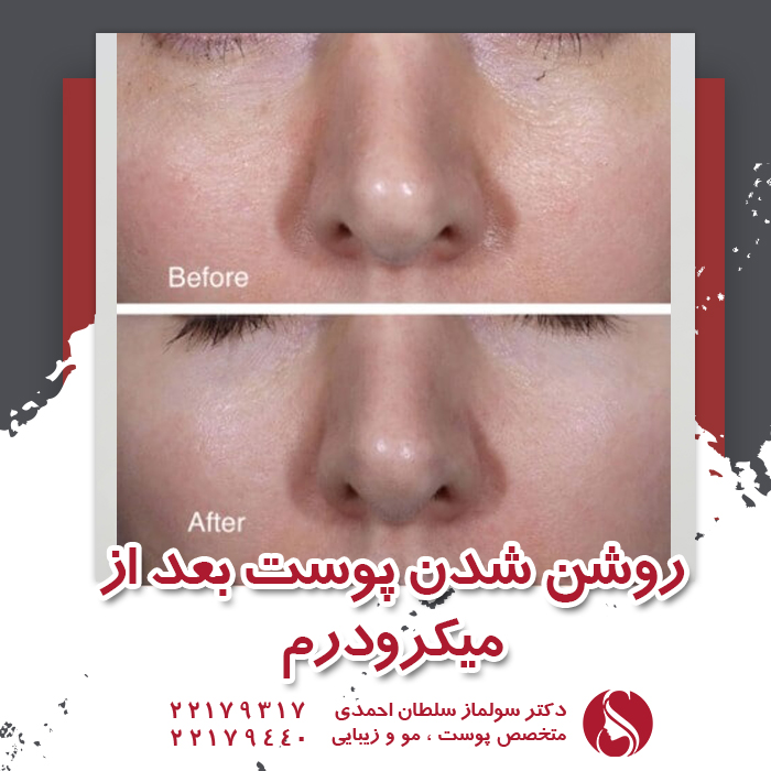 نمونه میکرودرم قبل و بعد