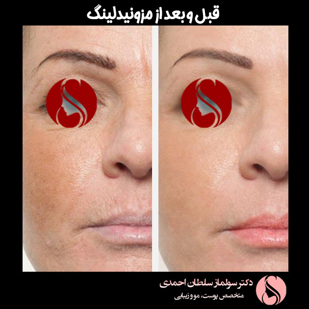 قبل و بعد مزونیدلینگ