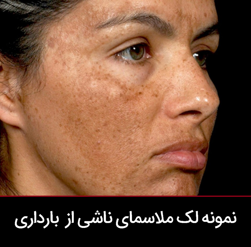 ملاسمای بارداری