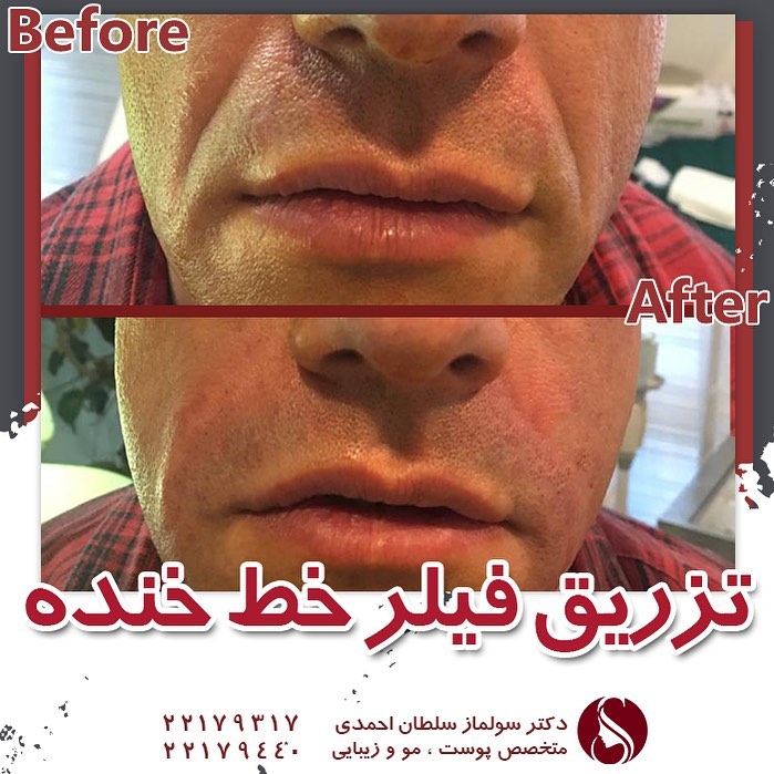 خط خنده و درمان آن