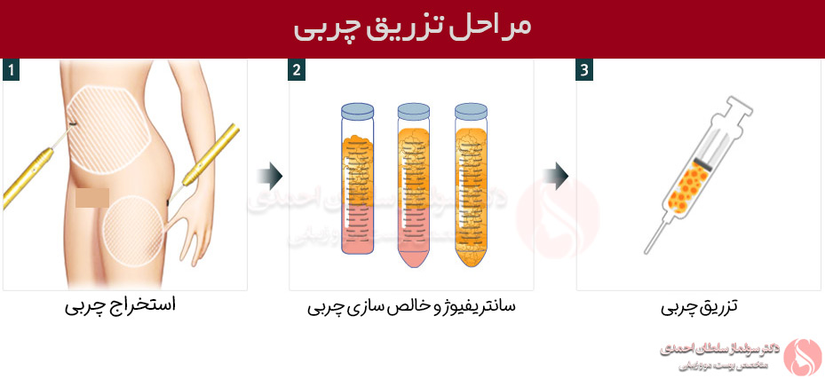 مراحل تزریق چربی به صورت