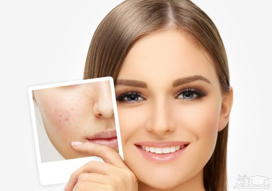جوش های کیست شکل