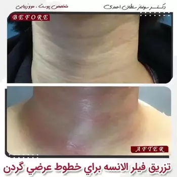تزریق فیلر الانسه