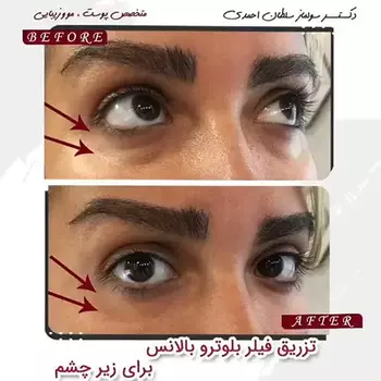 تزریق فیلر بلوترو