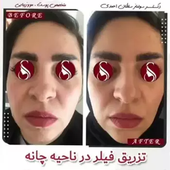 تزریق فیلر در چانه