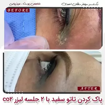 پاک کردن تتو سفید