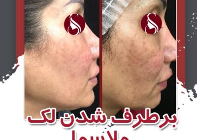 رفع لکه ملاسما توسط دکتر سلطان احمدی