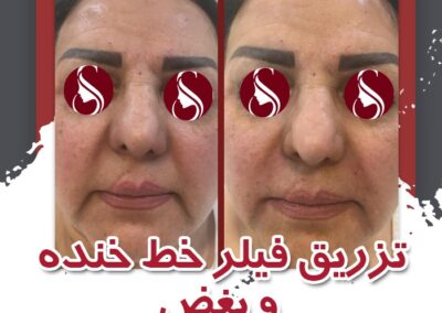 تزریق فیلر برای رفع خط خنده دکتر سلطان احمدی