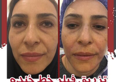 تزریق فیلر خنده دکتر سلطان احمدی