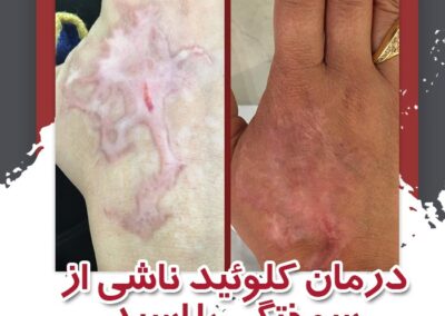 درمان کلوئید ناشی از سوختگی
