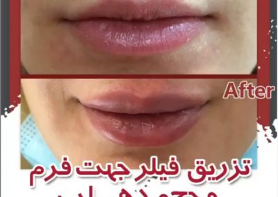 تزریق فیلر لب دکتر سلطان احمدی