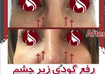 تزریق فیلر زیر چشم