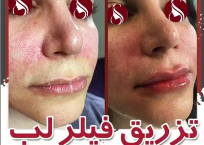 تزریق فیلر لب