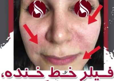 فیلر خط خنده بغض و گونه