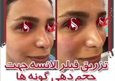 تزریق فیلر الانسه برای گونه ها