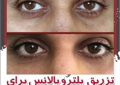 تزریق بلتروبالانس گودی زیرچشم