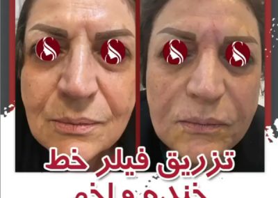 تزریق فیلر خط خنده