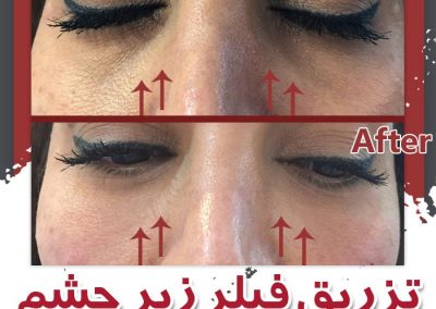 تزریق فیلر زیر چشم