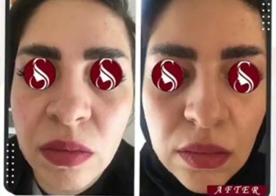 تزریق فیلر در چانه