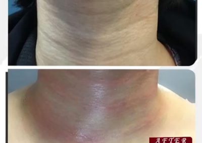 رفع خطوط گردن با تزریق فیلر