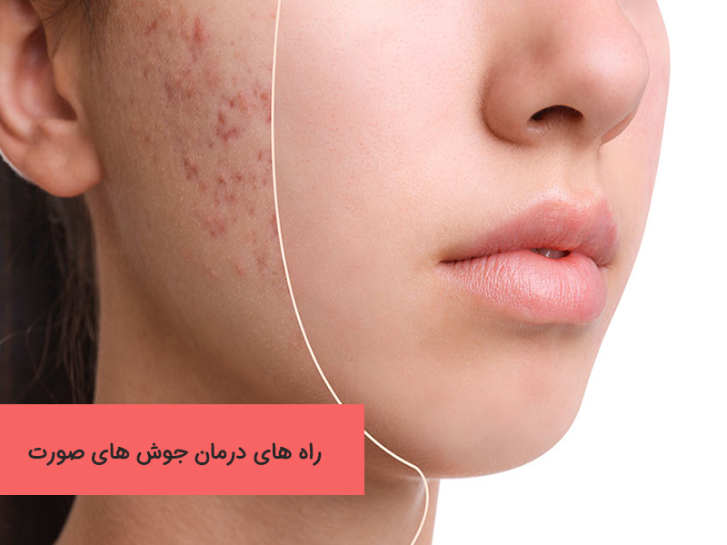 انواع جوش صورت و راه های درمان آنها